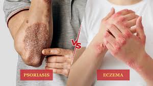 Psoriasis Treatment in Kalwa