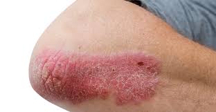 Psoriasis Treatment in Kalwa